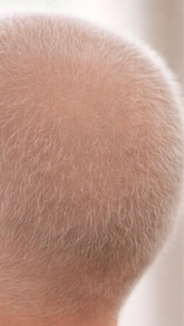 Scalp and hair