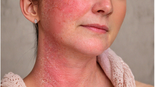 Red and Irritated Skin