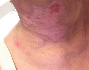 Radiodermatitida: jak pečovat o pokožku po ozařování