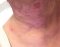 Radiodermatitis: pielęgnacja skóry po radioterapii